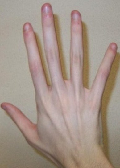 Hand of a patient suffering from Marfan Syndrome