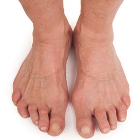 The feet of a diver suffering from rheumatoid arthritis