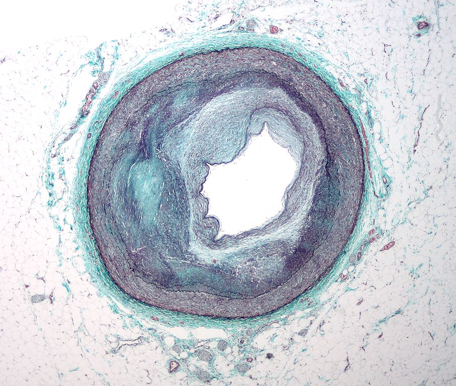 Complex atherosclerosis of the right coronary artery shown on a low magnification micrograph