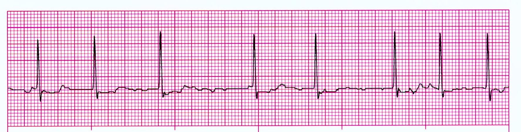 Heart rhythm for a diver with Atrial Fibrillation, also known as AFib