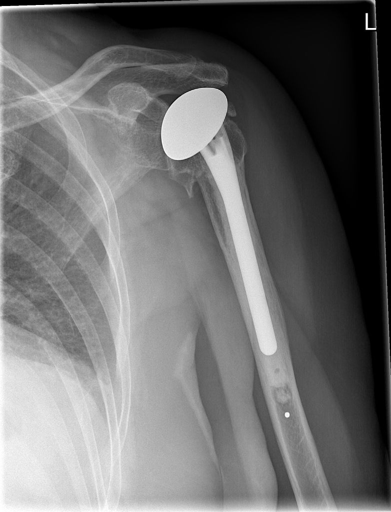 Xray of diver with shoulder prosthesis after suffering from dysbaric osteonecrosis