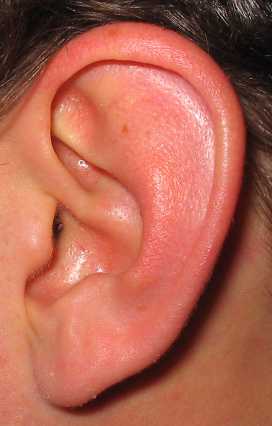 Close up of a diver&#039;s left ear before his inner ear surgery