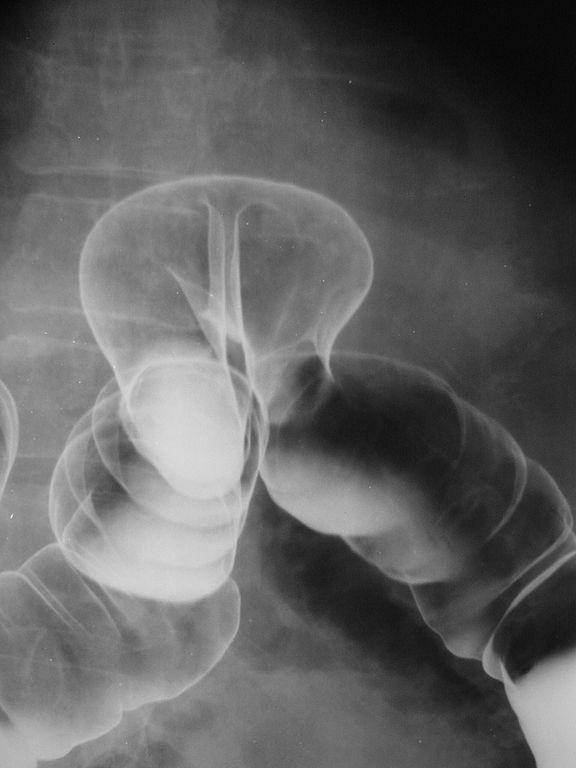 Xray of diver's colon showing a hernia in the colon which should be repaired before he returns to diving