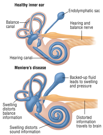 Diagram of a healthy inner ear and an inner ear with Meniere&#039;s Disease, an inner ear disorder
