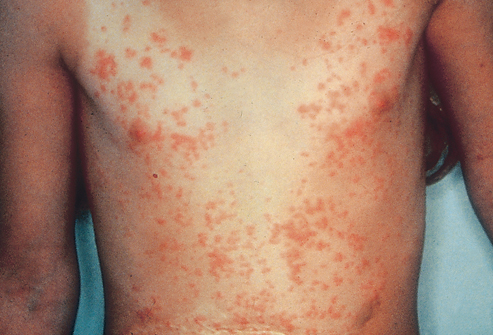 Young male diver with Sea Bather's Eruption over his chest and stomach