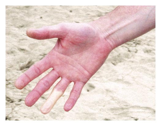 Male diver with Raynaud's Symptoms extends his fingers over the sand after a dive.